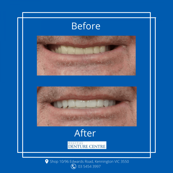 Before and After 11 — Denture Clinic in Bendigo, VIC