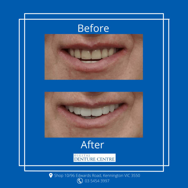 Before and After 13 — Denture Clinic in Bendigo, VIC