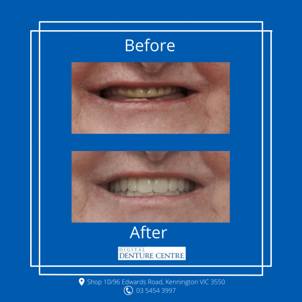 Before and After 14 — Denture Clinic in Bendigo, VIC