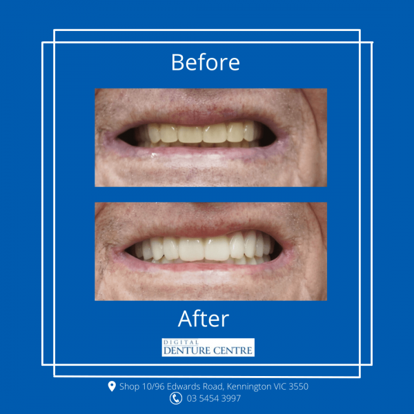 Before and After 15 — Denture Clinic in Bendigo, VIC