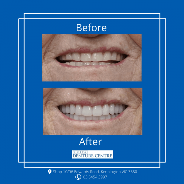 Before and After 16 — Denture Clinic in Bendigo, VIC