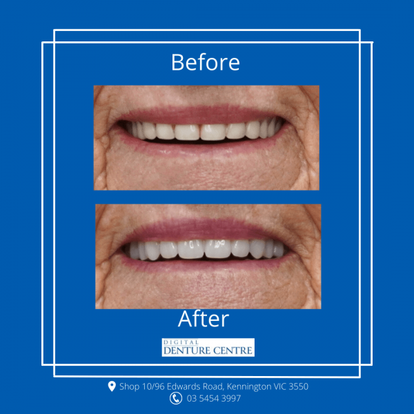 Before and After 17 — Denture Clinic in Bendigo, VIC