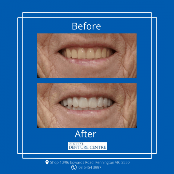 Before and After 18 — Denture Clinic in Bendigo, VIC