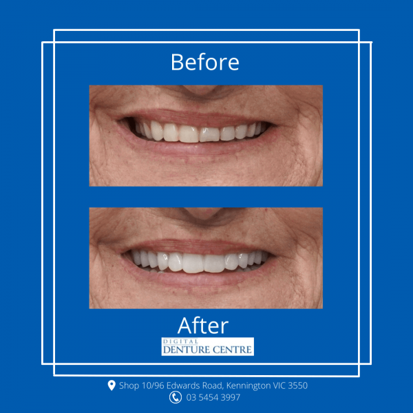 Before and After 20 — Denture Clinic in Bendigo, VIC