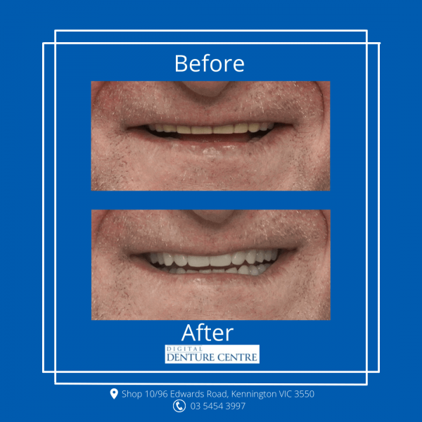 Before and After 21 — Denture Clinic in Bendigo, VIC