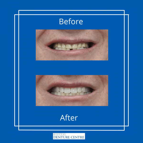 Before and After 23 — Denture Clinic in Bendigo, VIC