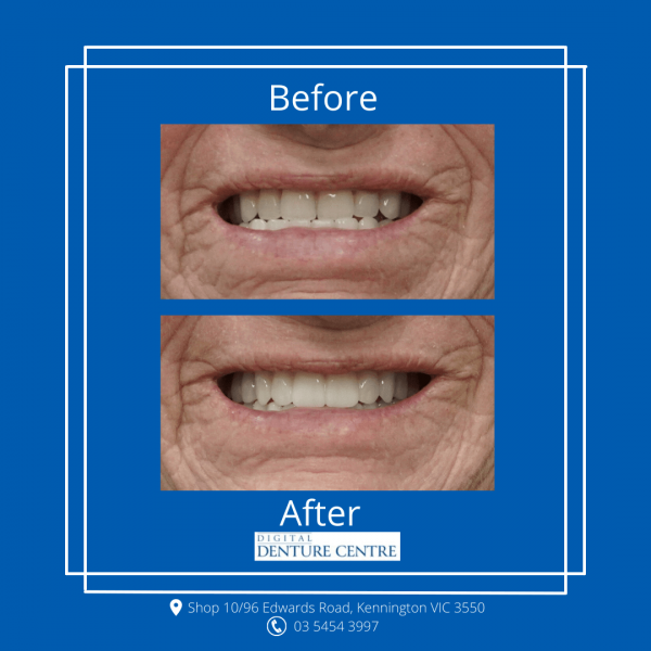 Before and After 25 — Denture Clinic in Bendigo, VIC