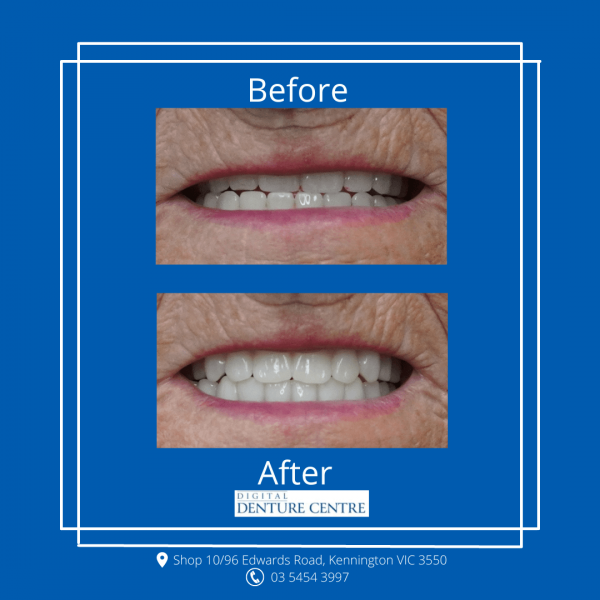 Before and After 26 — Denture Clinic in Bendigo, VIC