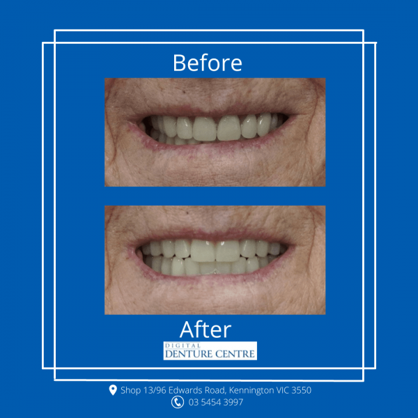 Before and After 27 — Denture Clinic in Bendigo, VIC