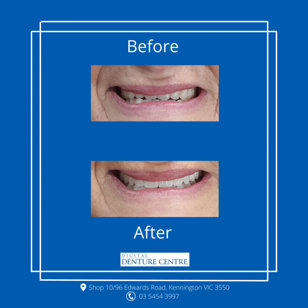 Before and After 3 — Denture Clinic in Bendigo, VIC