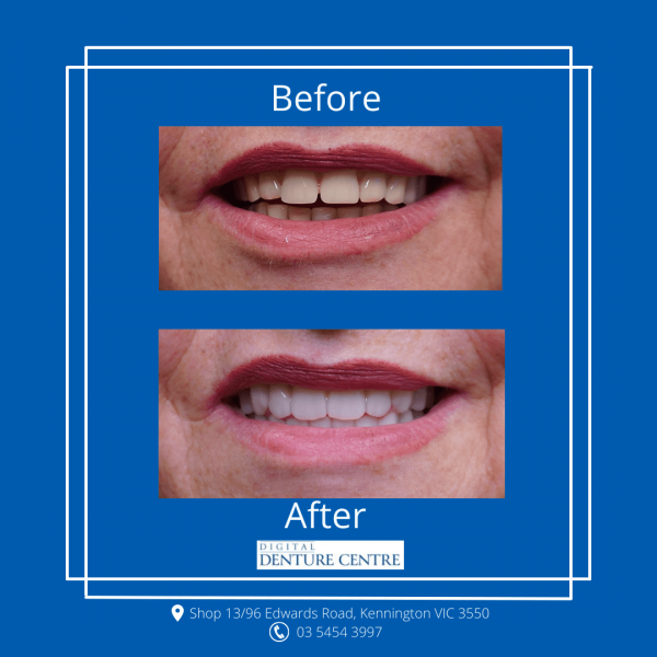 Before and After 33 — Denture Clinic in Bendigo, VIC