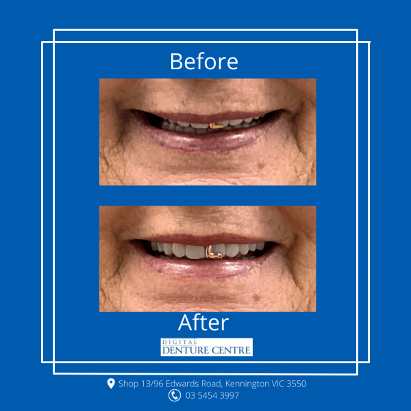 Before and After 34 — Denture Clinic in Bendigo, VIC