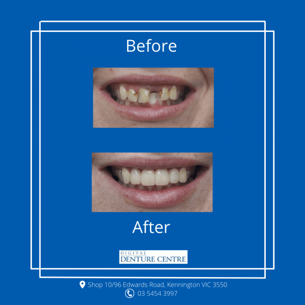Before and After 4 — Denture Clinic in Bendigo, VIC