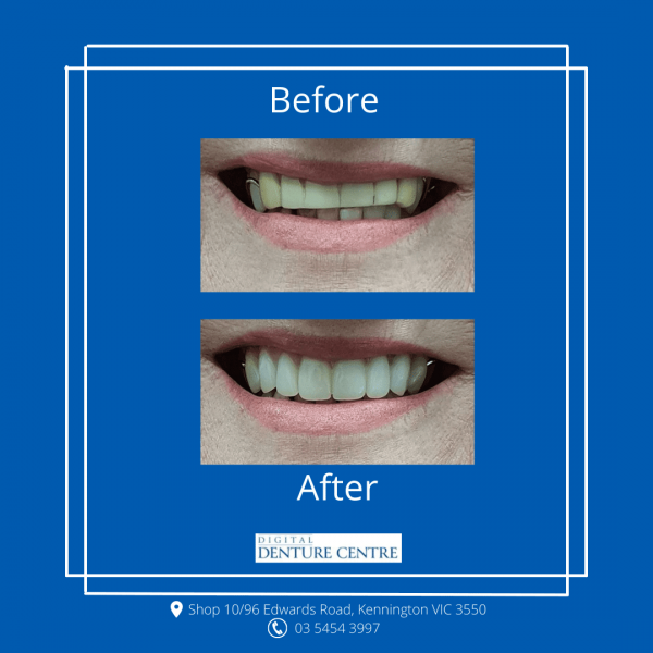 Before and After 7 — Denture Clinic in Bendigo, VIC