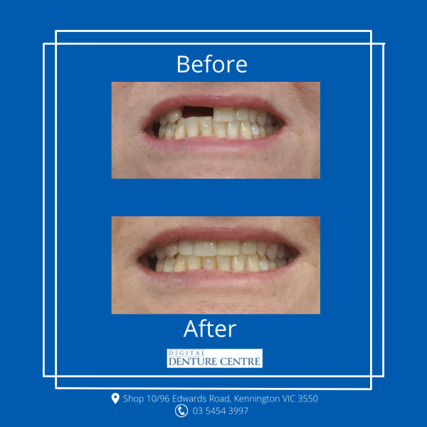 Before and After 9 — Denture Clinic in Bendigo, VIC