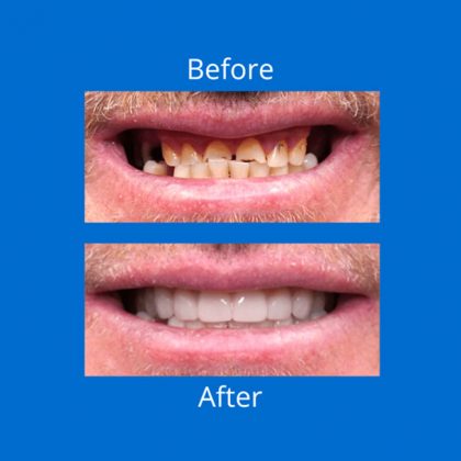 Before And After Dental Care — Digital Denture Centre in Kennington, VIC