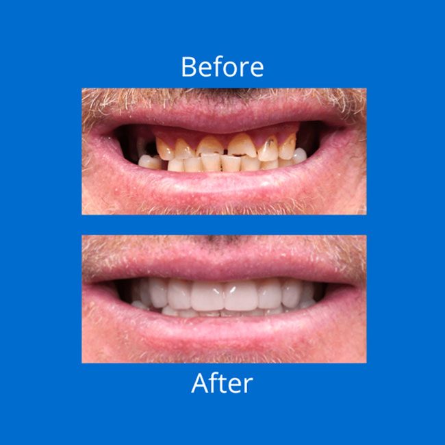 Before And After Dental Care — Digital Denture Centre in Kennington, VIC