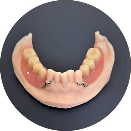 Closer-up View of Partial Denture — Denture Clinic in Bendigo, VIC