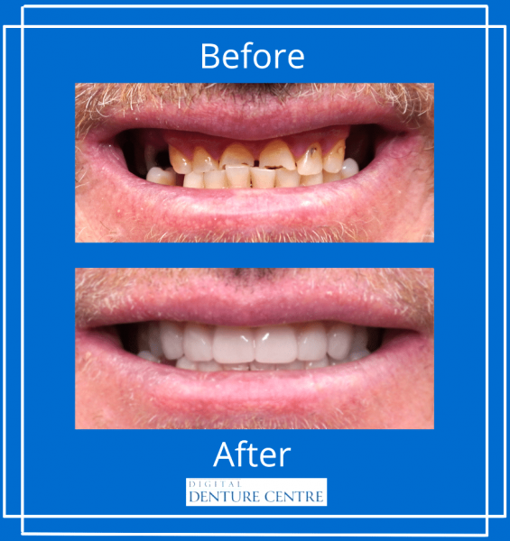 Before And After Dental Care — Digital Denture Centre in Kennington, VIC