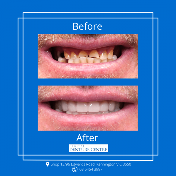 Before And After Dental Care — Digital Denture Centre in Kennington, VIC